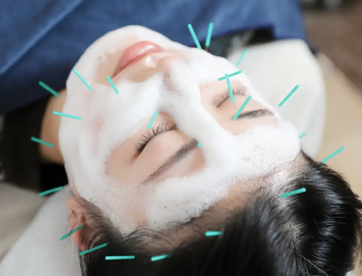 美容鍼